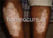 Leucoderma patient at HomeoCure®