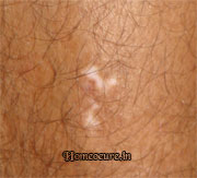 Leucoderma patient at HomeoCure®