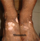 Leucoderma patient at HomeoCure®