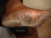 psoriasis patient at HomeoCure® (Before Treatment)