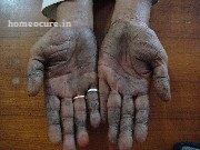 psoriasis patient at HomeoCure® (Before Treatment)