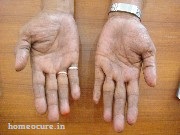 psoriasis patient at HomeoCure® (After Treatment)