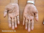 psoriasis patient at HomeoCure® (After Treatment)