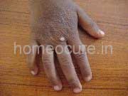 Warts and Mole patient at HomeoCure®