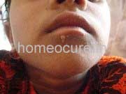 Warts and Mole patient at HomeoCure®