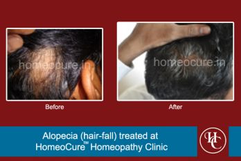 Testimonial of alopecia (hair-loss) treated at HomeoCure Clinic, Pune